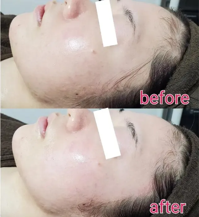 グリーンハーブ🌿前後 小顔、引き締め