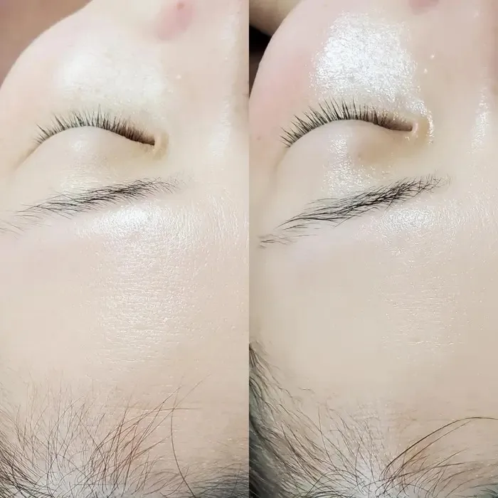 ブラックハーブ🌿前後 おでこのシワ