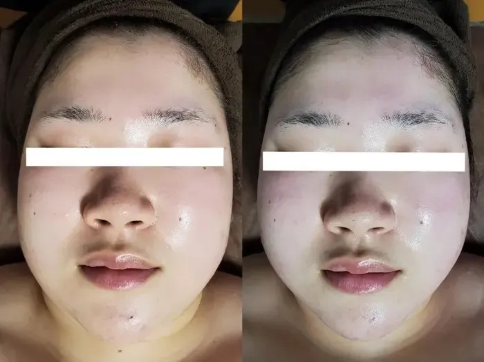 フォースカッター フェイシャル