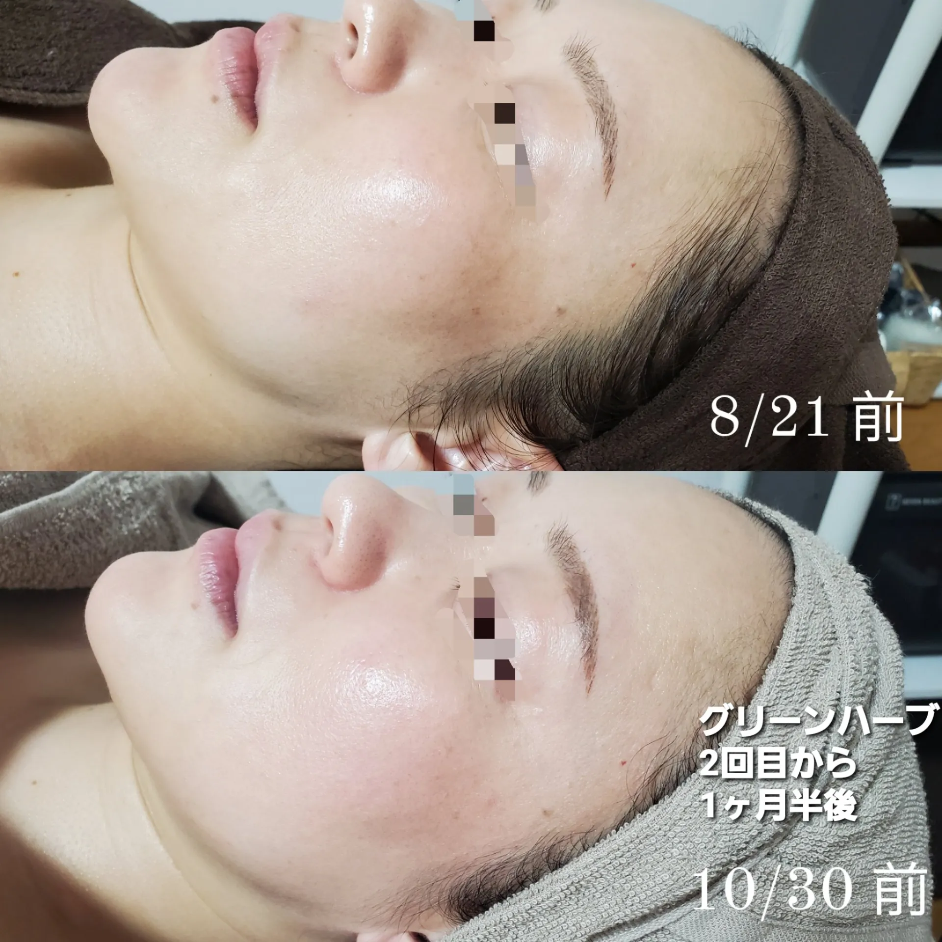 ハーブピーリング 2回