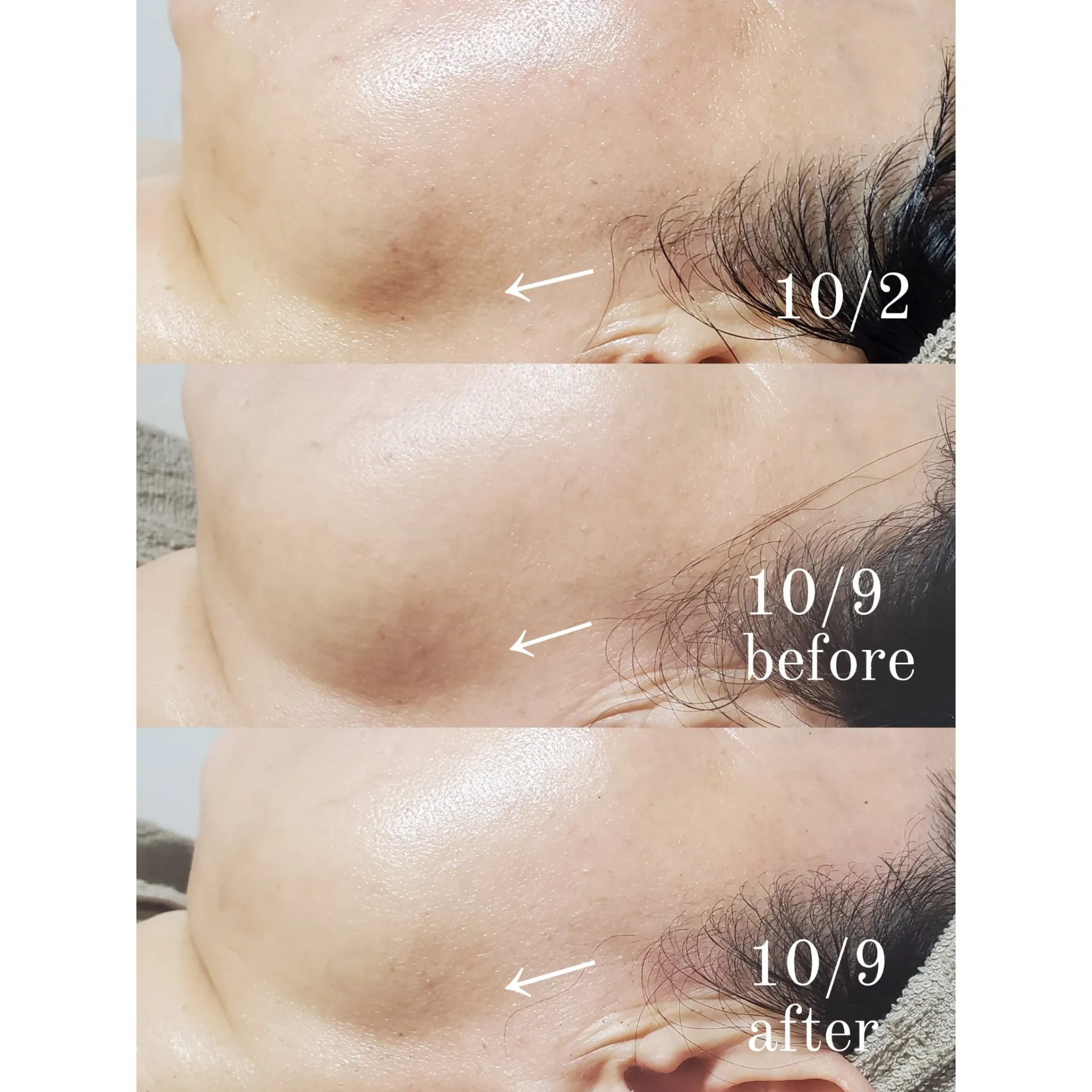 ハーブピーリング 1回