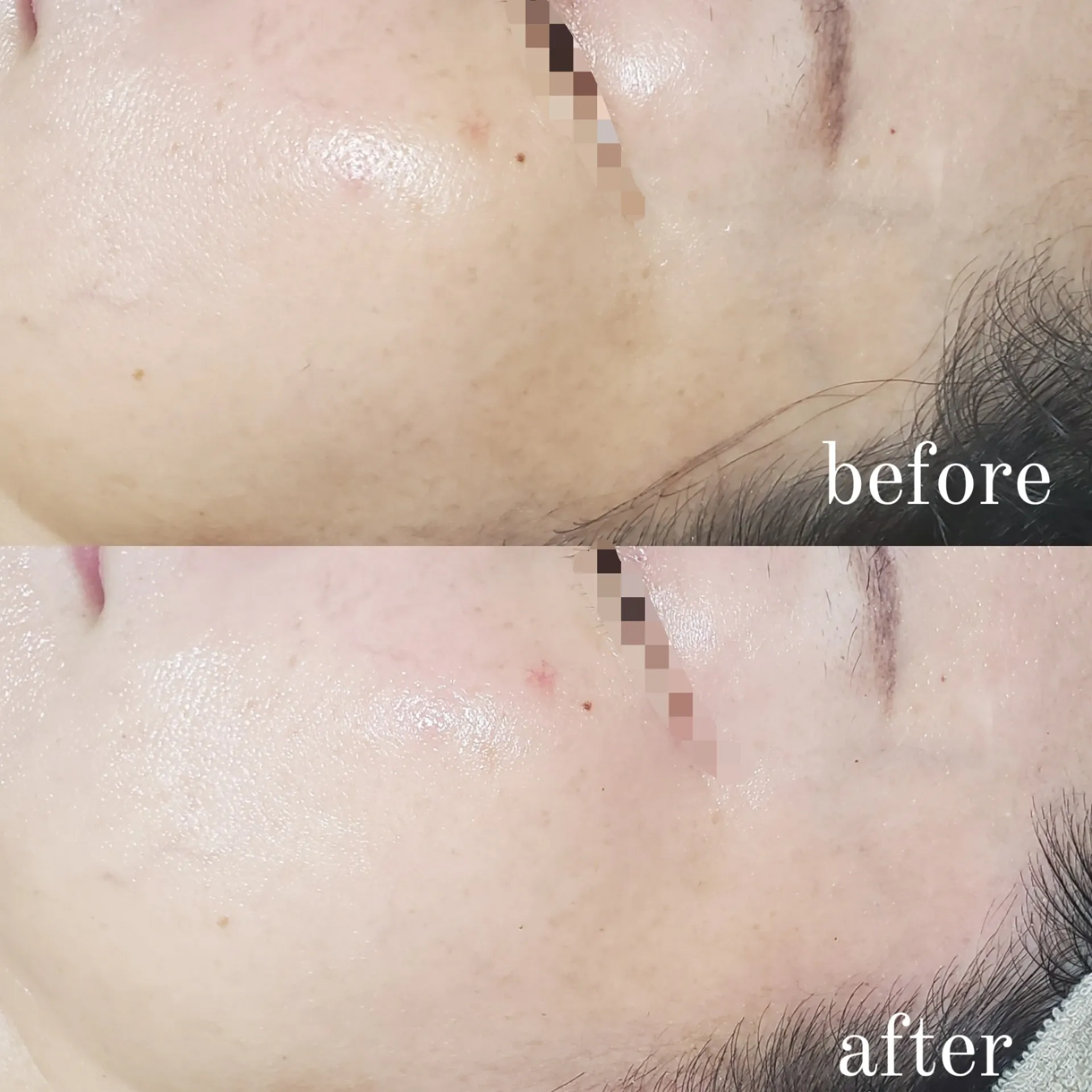 ハーブピーリング 1回